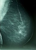 Foto: Las mujeres nacidas de madres con edad avanzada tienen más riesgo de cáncer de mama (WIKIPEDIA/A. AVENDAÑO)