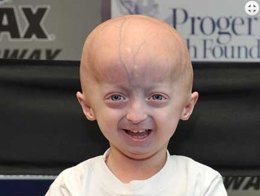 Foto: Científicos descubren un tratamiento prometedor para la progeria (PROGERIA RESEARCH FOUNDATION)