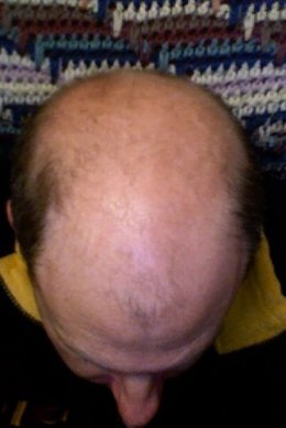 Foto: Las vitaminas y champús cosméticos para la alopecia no tienen "ninguna" efectividad médica y no frenan la caída del pelo (SMOBSERVER / EN.WIKIPEDIA)