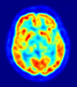Foto: El tratamiento temprano tras un ictus, reduce el riesgo de muerte en el hospital (JENS LANGNER )