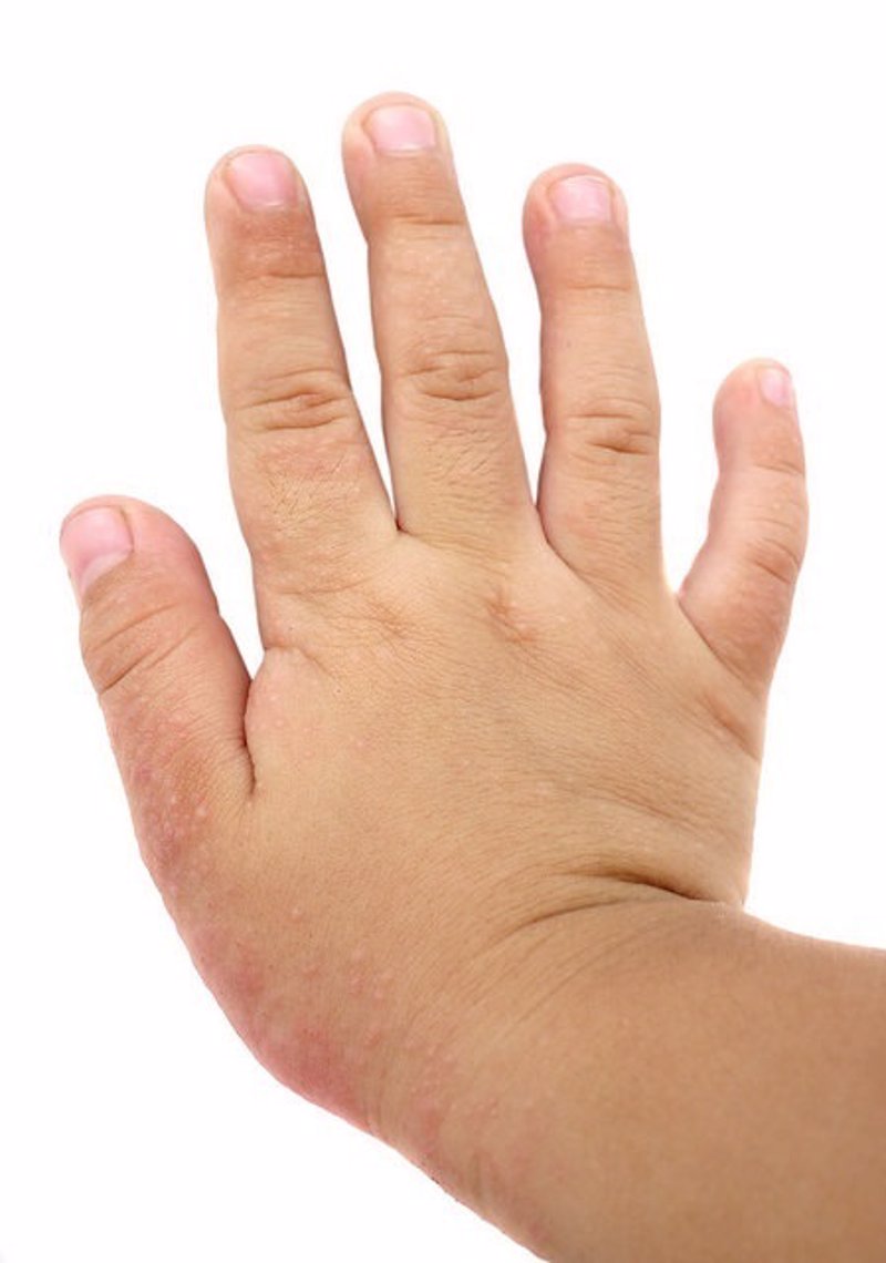 Sanbyulleten por la psoriasis